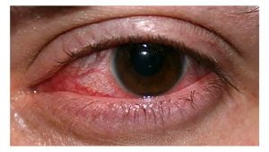 Red Eye Infection in Karachi